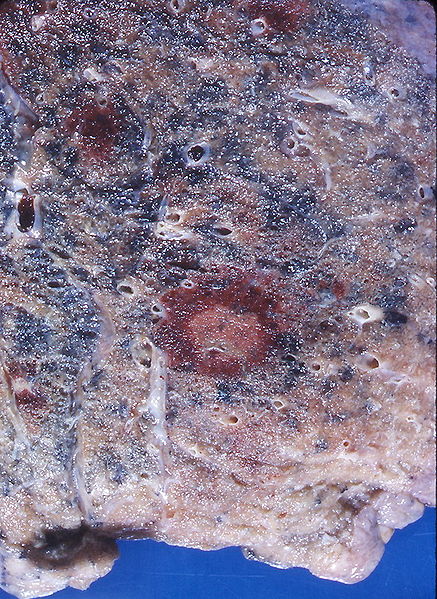 Aspergillose (Lunge, B44.9) - PATHO-logisch - Das Pathologie Portal